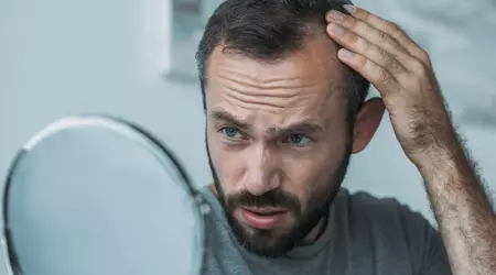 Los científicos han descubierto una propiedad inesperada del azúcar del ADN que podría solucionar la caída del cabello en hombres y mujeres
