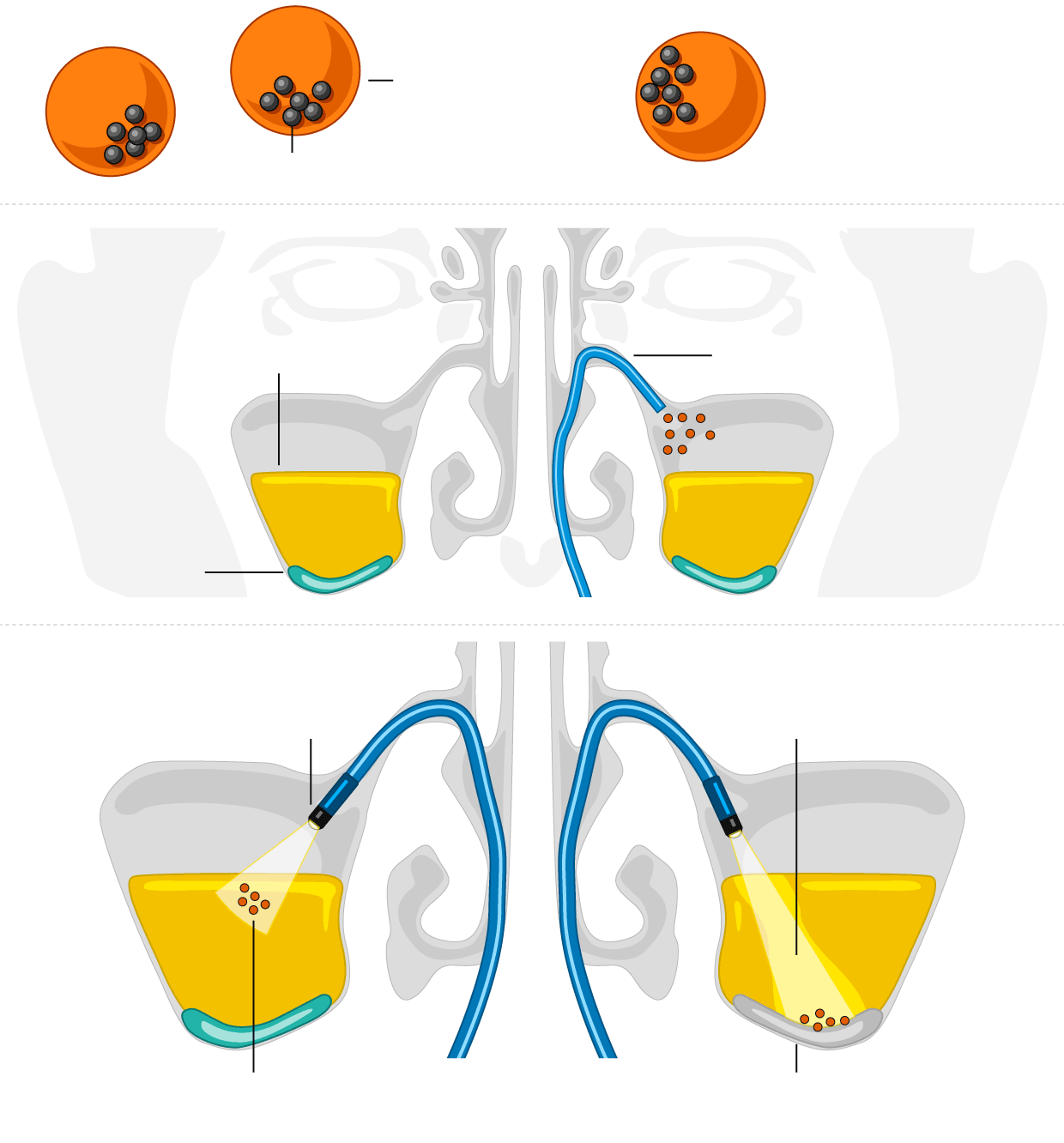 Cómo funcionan los microrobots (escala no mostrada). Ilustración: Guardian Ilustración de microrobots para el tratamiento de sinusitis
